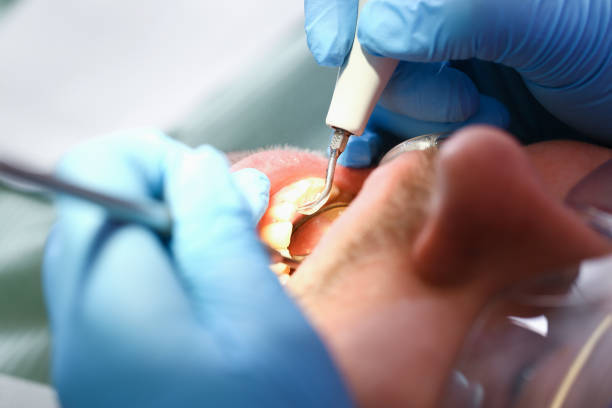 Best Emergency Tooth Extraction in Crosby, TX