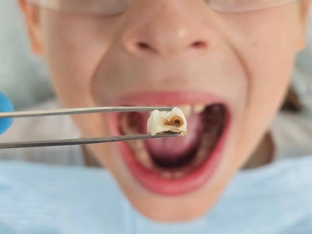 Best Emergency Wisdom Teeth Removal in Crosby, TX